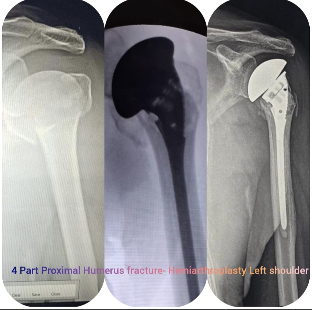 Shoulder replacement treatment